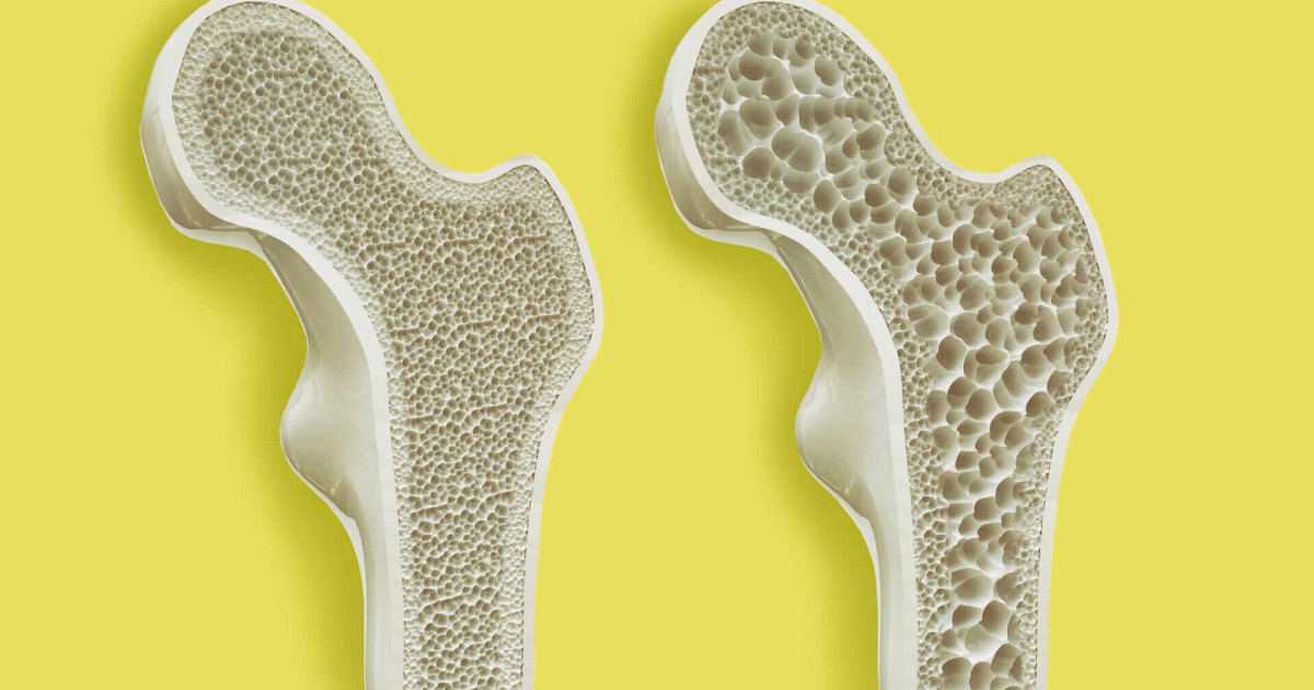 osteoporosis